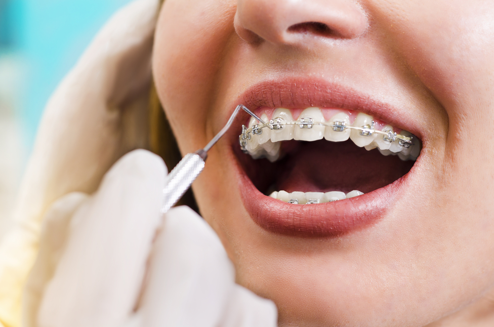 Orthodontic treatment at Dr. Bruce Edward King Dental Practice